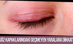 Göz kapaklarındaki geçmeyen yaralara dikkat!