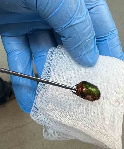 Ağrı ve işitme kaybı nedeniyle hastaneye gitti, kulağından Japon böceği çıktı